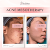 Acne Mesotherapy