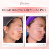 Brightening Chemical Peel