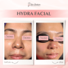 Hydra Facial