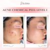 Acne Chemical Peel Level 1