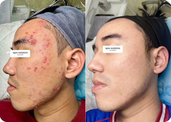 Da yếu - Mụn viêm - Thâm sẹo