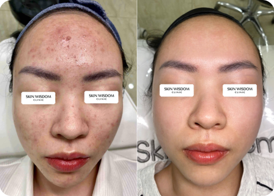 Case tăng sắc tố
