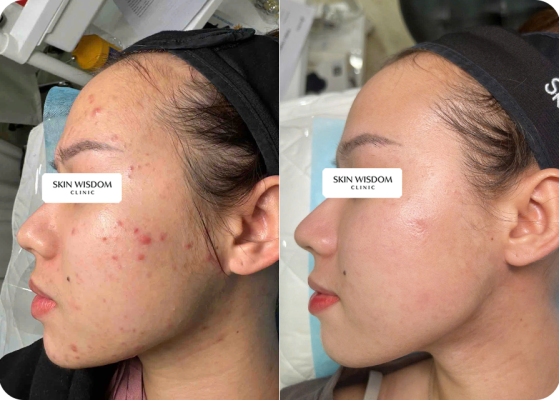 Case da dầu bị mụn