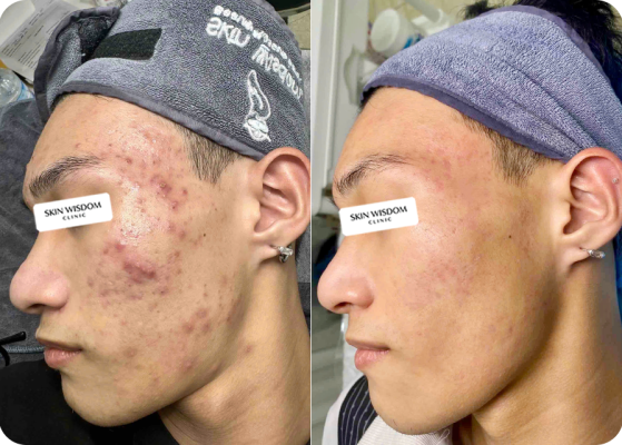 Phác đồ cá nhân hoá da mụn viêm, sẹo mới hình thành