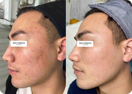 điều trị mụn cho nam giới